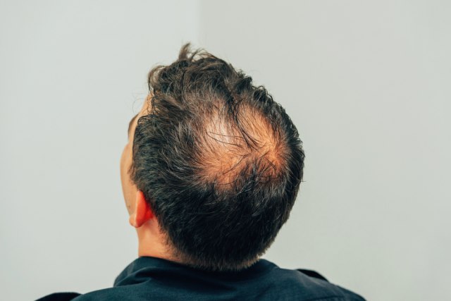 Æelavost postaje prošlost; Nauènici otkrili tehniku od koje raste nova kosa